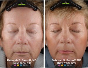 Co2 Fractional Resurfacing A Wrinkle In Time Vail Co Sharon Palm