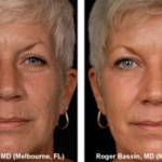 Laser Resurfacing, A Wrinkle in Time, Vail, CO